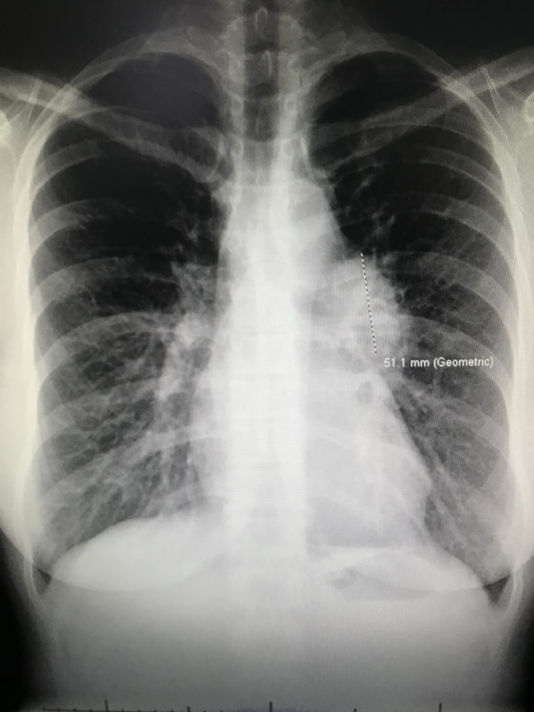 Samantha S. 1st chest X-ray