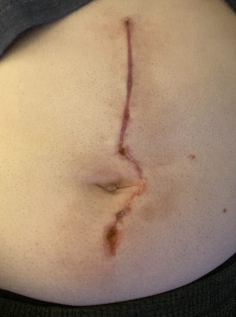 Image of scar from RPLND 3 weeks post surgery 