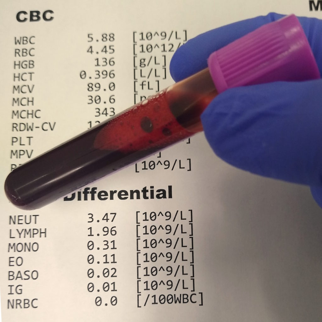 CBC test results