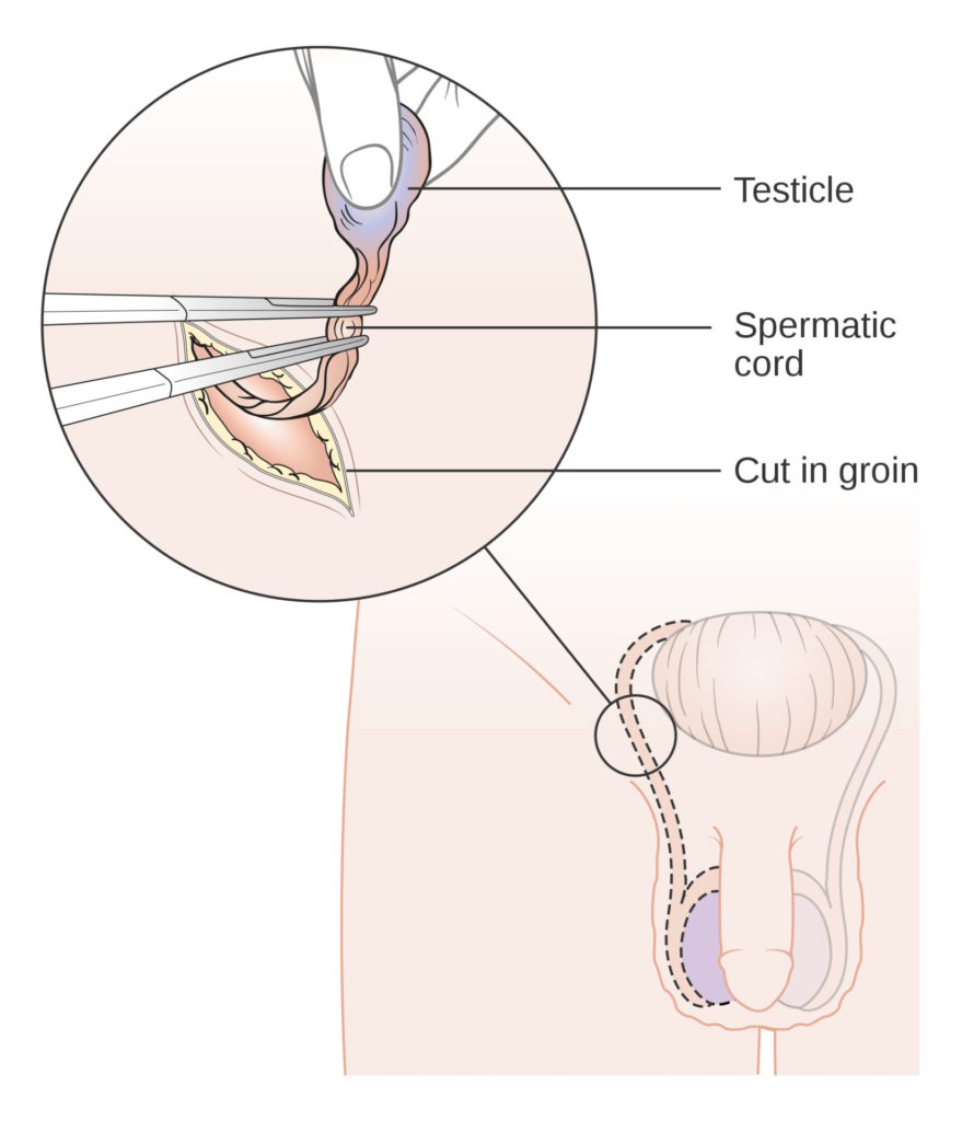 orchiectomy testicle removal surgery