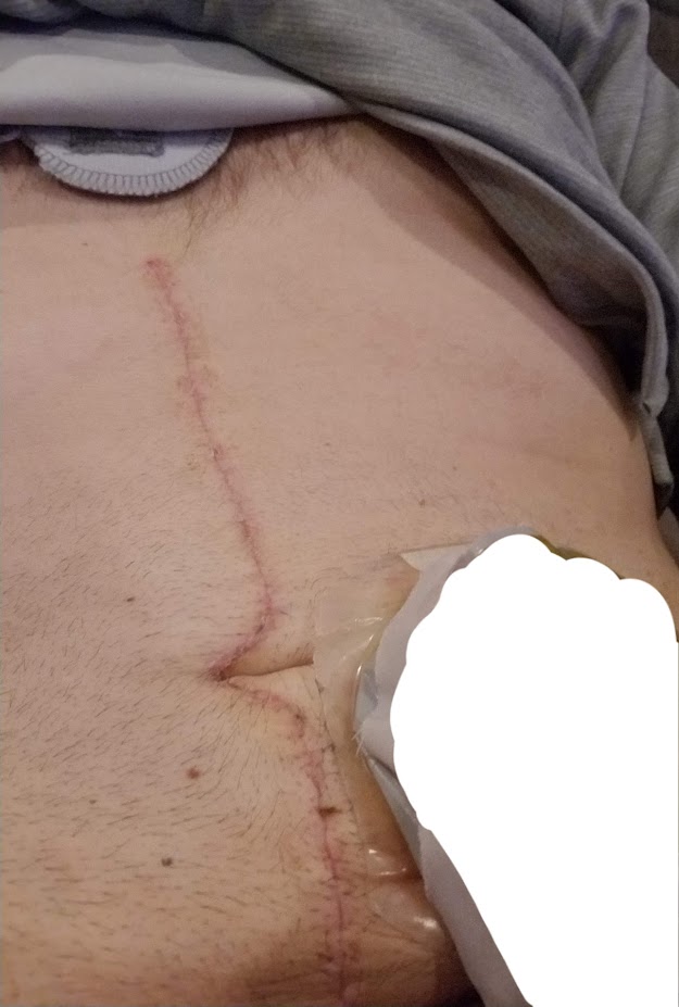 Jason recommends trying different ostomy bags to find what works for you