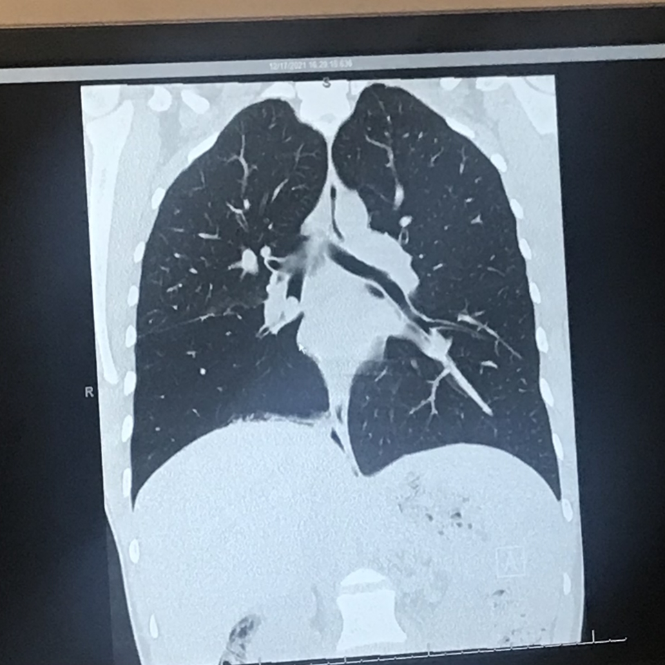 Lauren C. lung scan