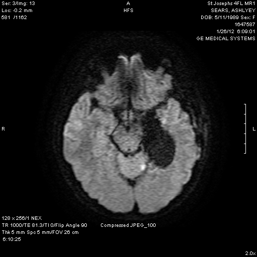 Ashley's brain scan post-surgery and tumor