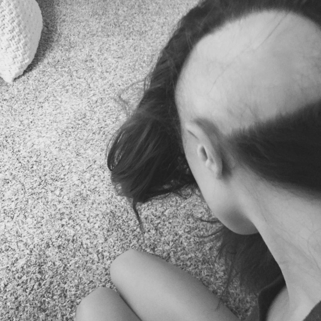 Ashley experienced unusual hair loss