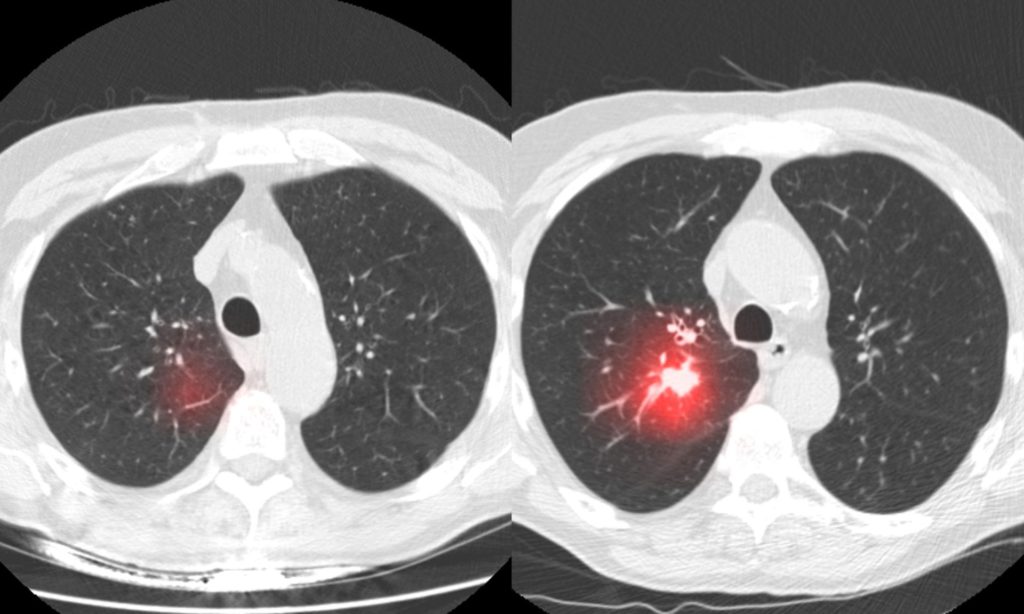 Dr. Sequist uses AI to evaluate people's risk of developing lung cancer