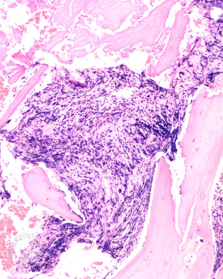 marrow fibrosis in primary myelofibrosis