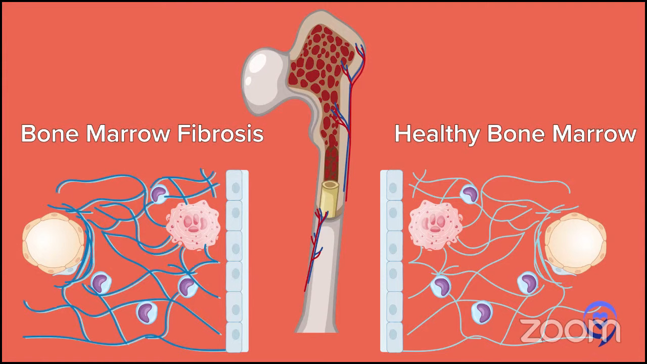 The Latest in Myelofibrosis Treatments - Clinical Trials