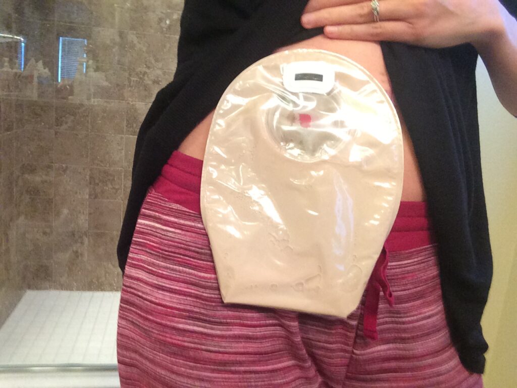She discusses the pros and cons of an ostomy