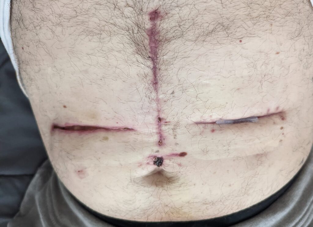 Jason's incision opened a second time but he didn't tell his doctor 