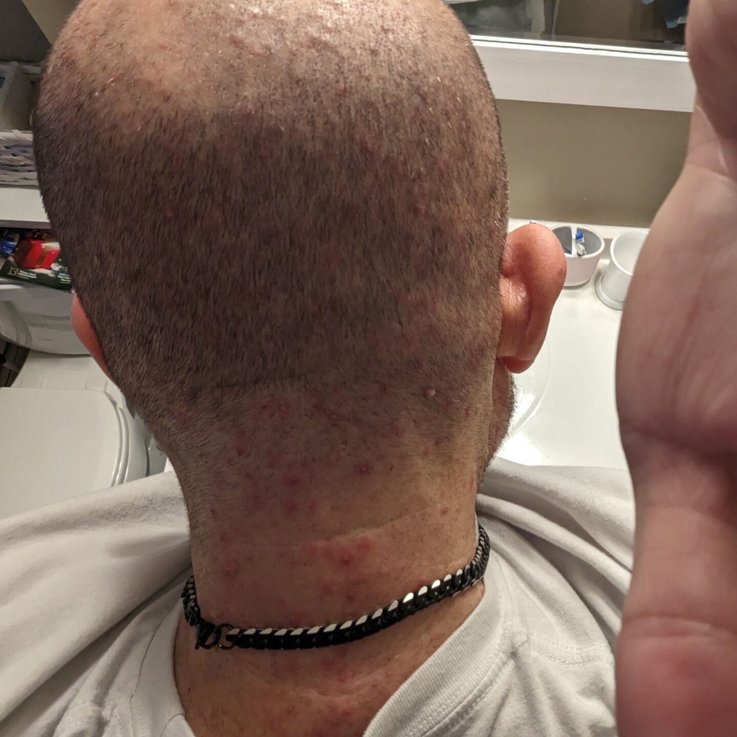 Jason had a skin outbreak following cancer treatment