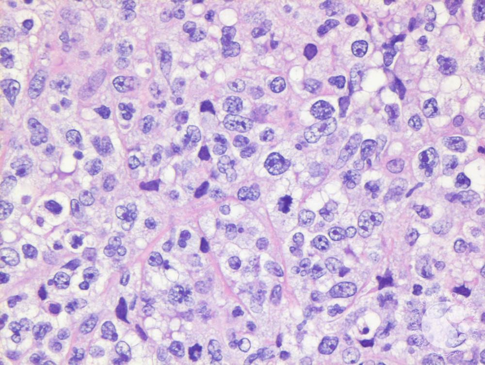 Primary Mediastinal B-cell Lymphoma PMBCL