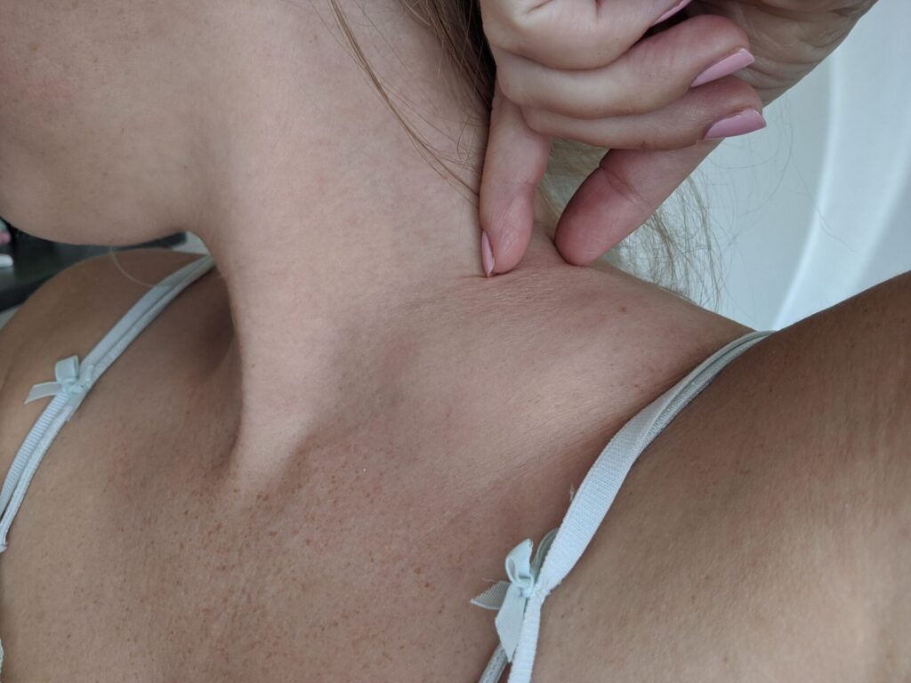 Alexandra noticed swollen lymph nodes on her shoulder