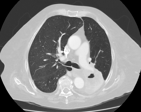 CT scan of lung cancer with cavitation