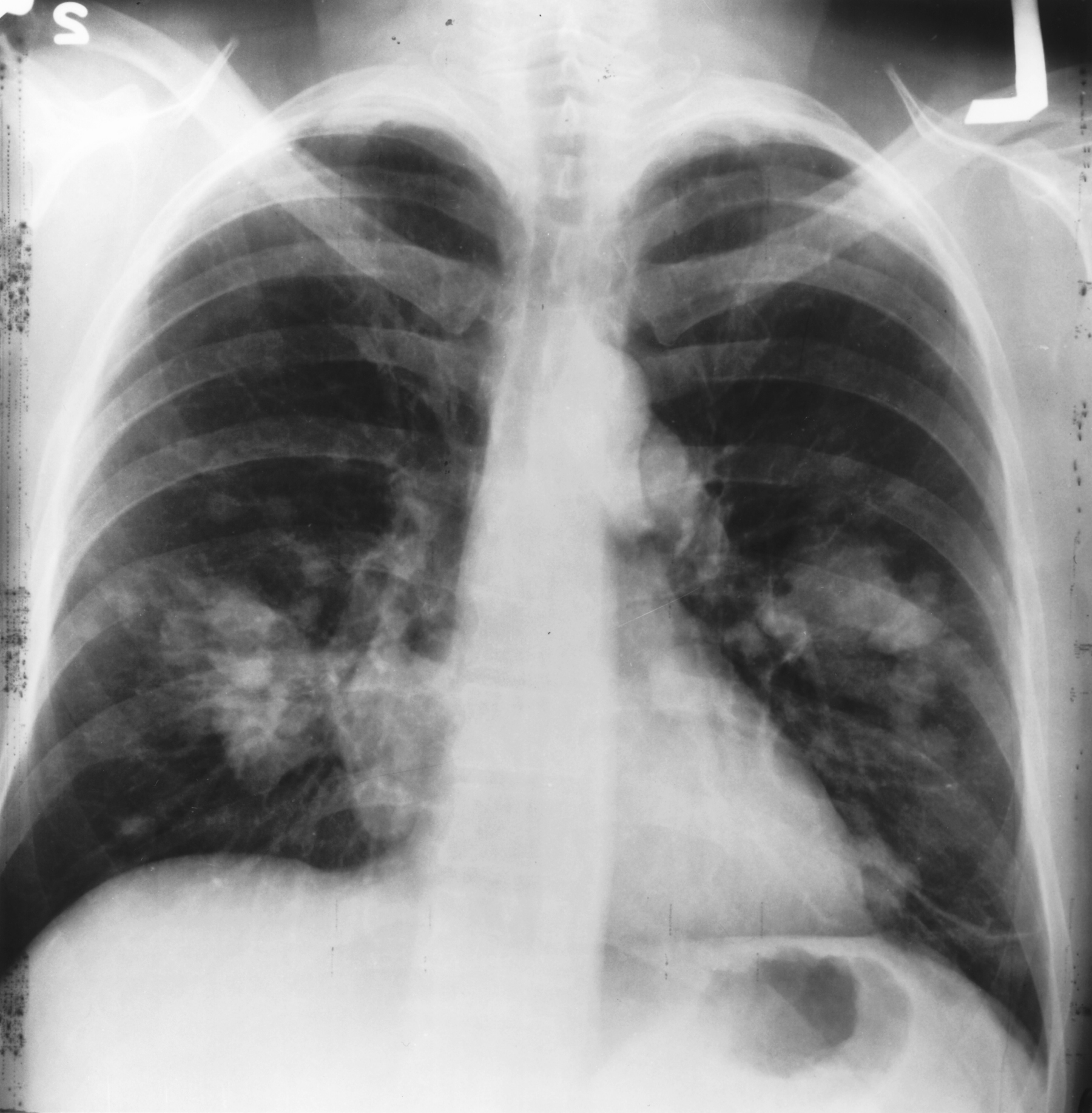 chest X-ray