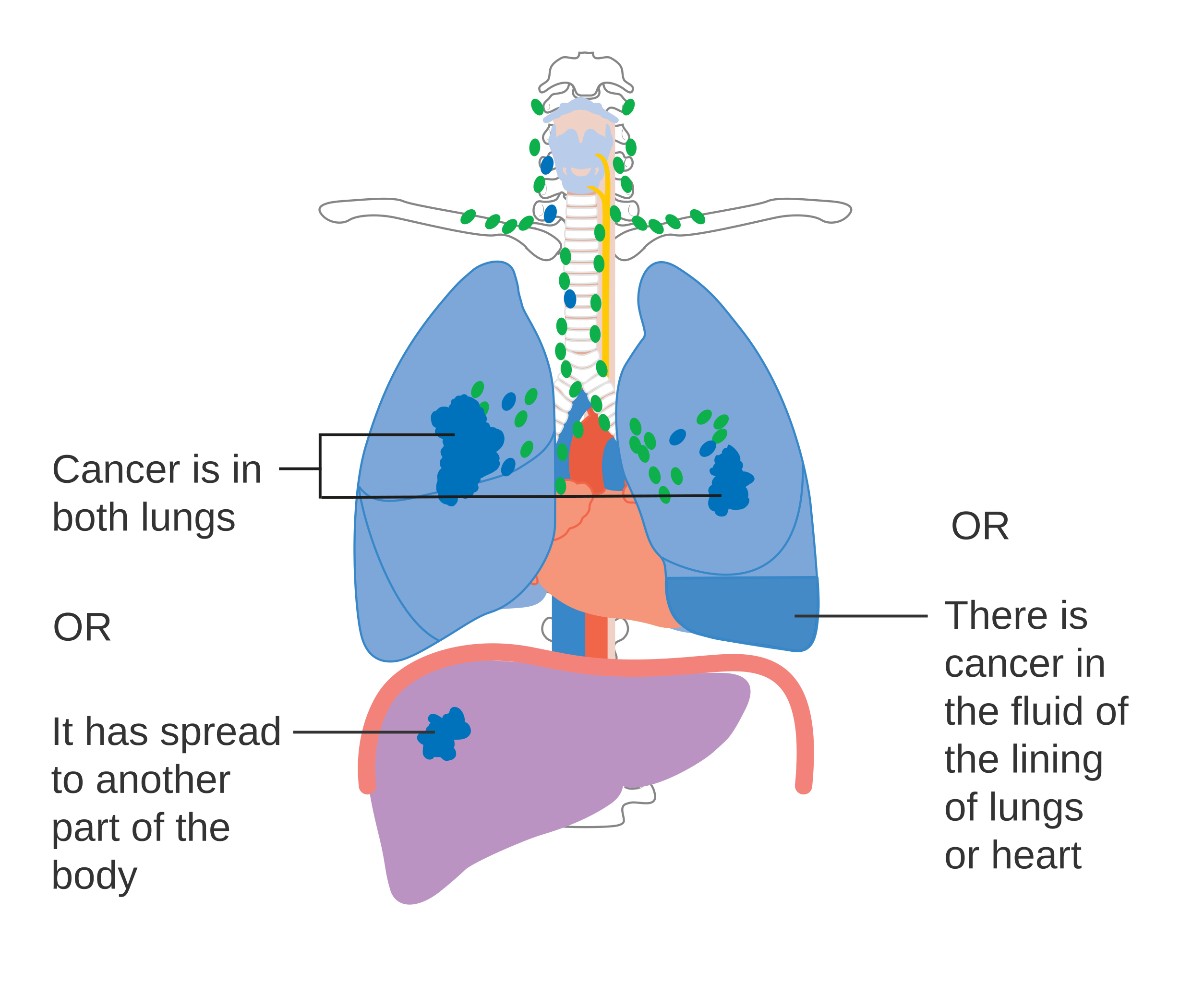 stage 4 lung cancer