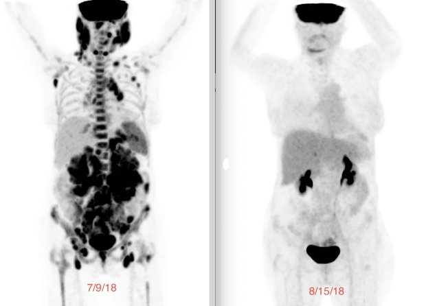 Demystifying Follicular Lymphoma - Latest Advances in Precision Medicine and Emerging Therapies