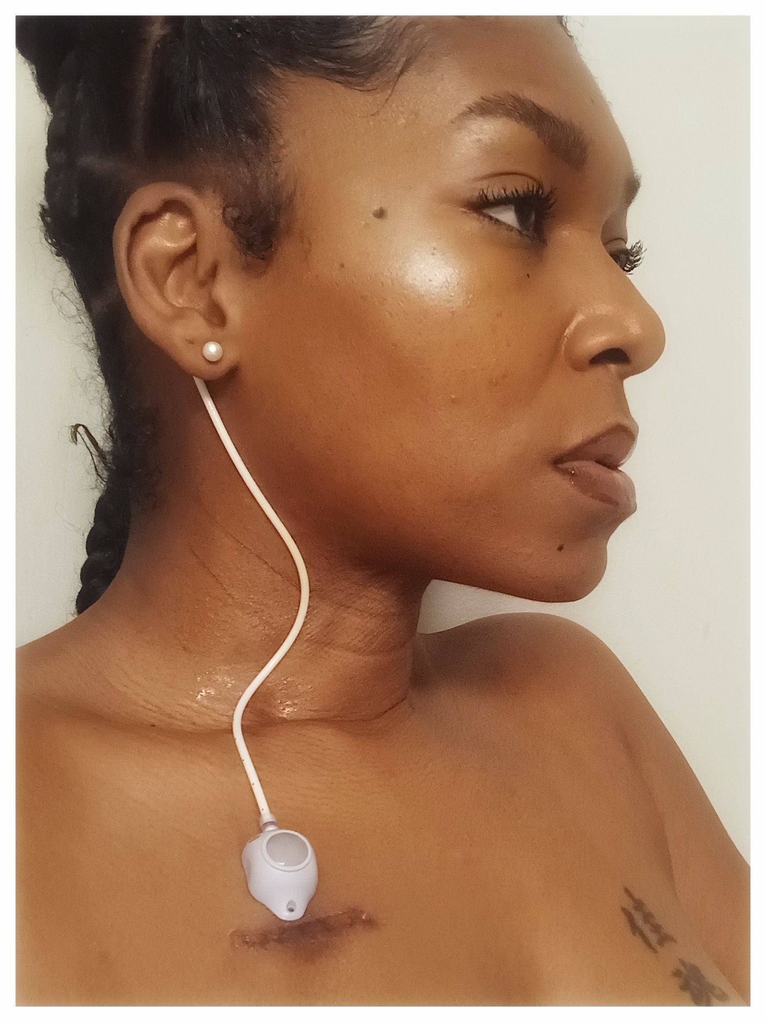 Erica R. stage 4b appendix cancer
