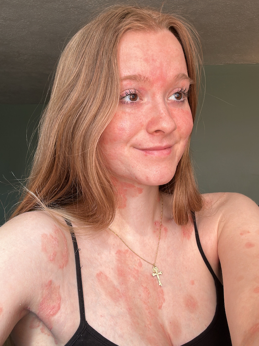 India B. psoriasis and psoriatic arthritis