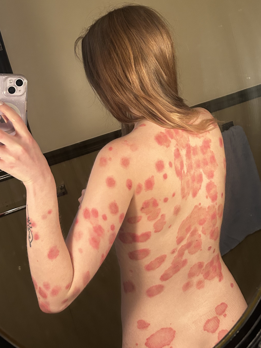 India B. psoriasis and psoriatic arthritis