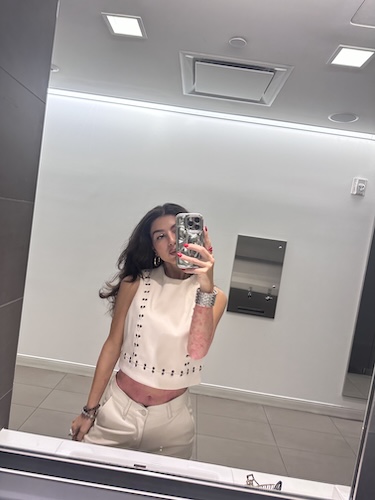 Alana O. psoriasis and psoriatic arthritis