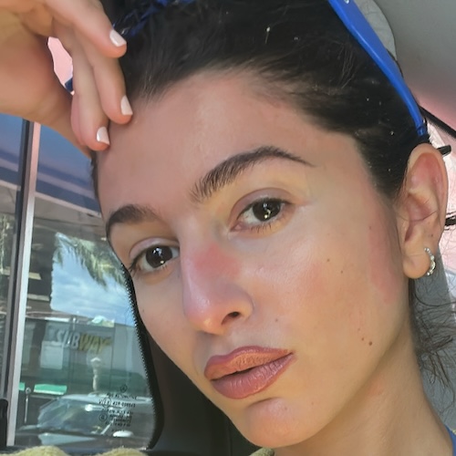 Alana O. psoriasis and psoriatic arthritis