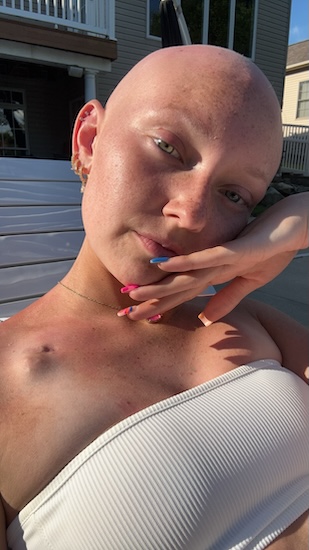 Alex P. stage 4 CIC-DUX4 sarcoma