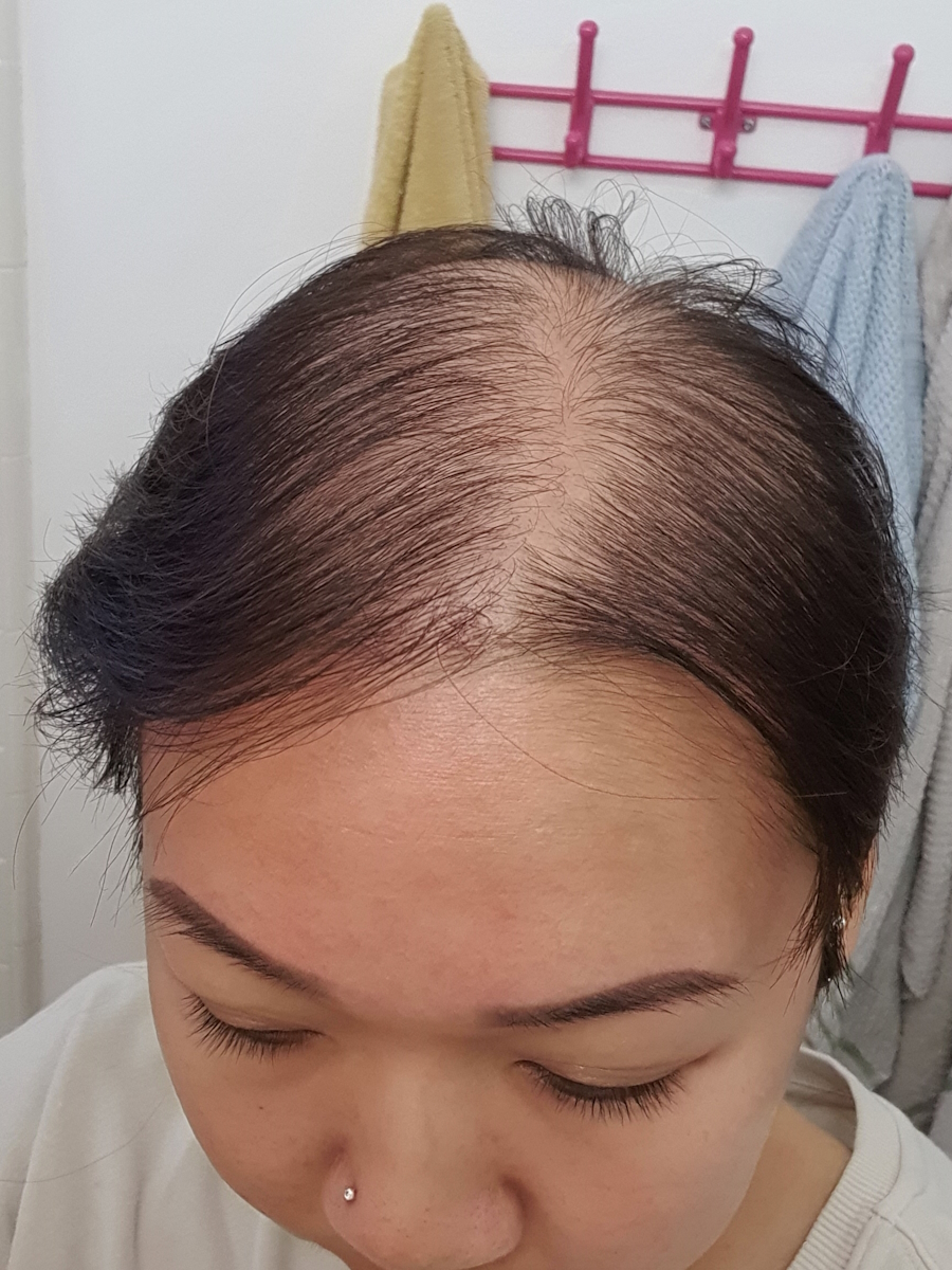 Anita T. stage 4 neuroendocrine carcinoma