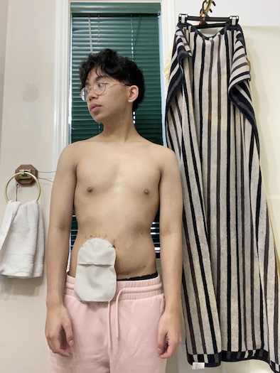 Ariel D. ulcerative colitis