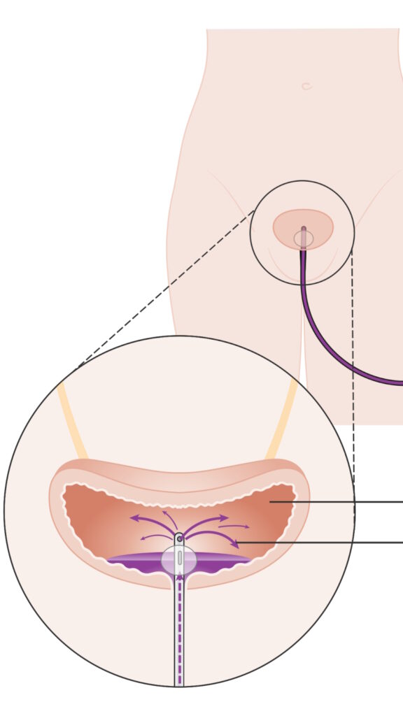 BCG immunotherapy