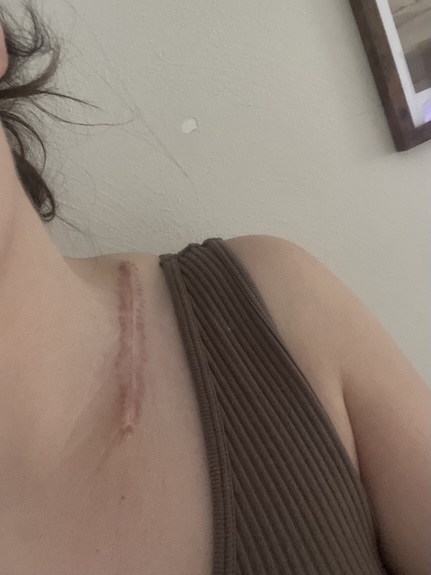 Ciarra D. dermatofibrosarcoma