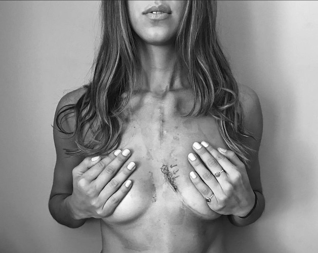 Julie K. stage 4 synovial sarcoma