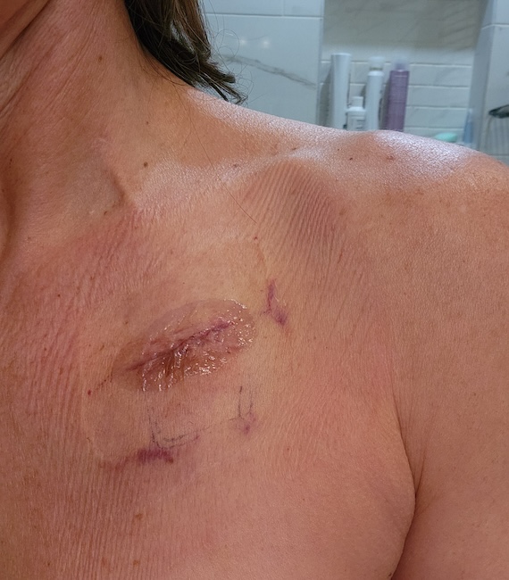 Kelly C. stage 4 colon cancer