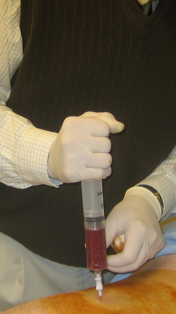 bone marrow aspiration