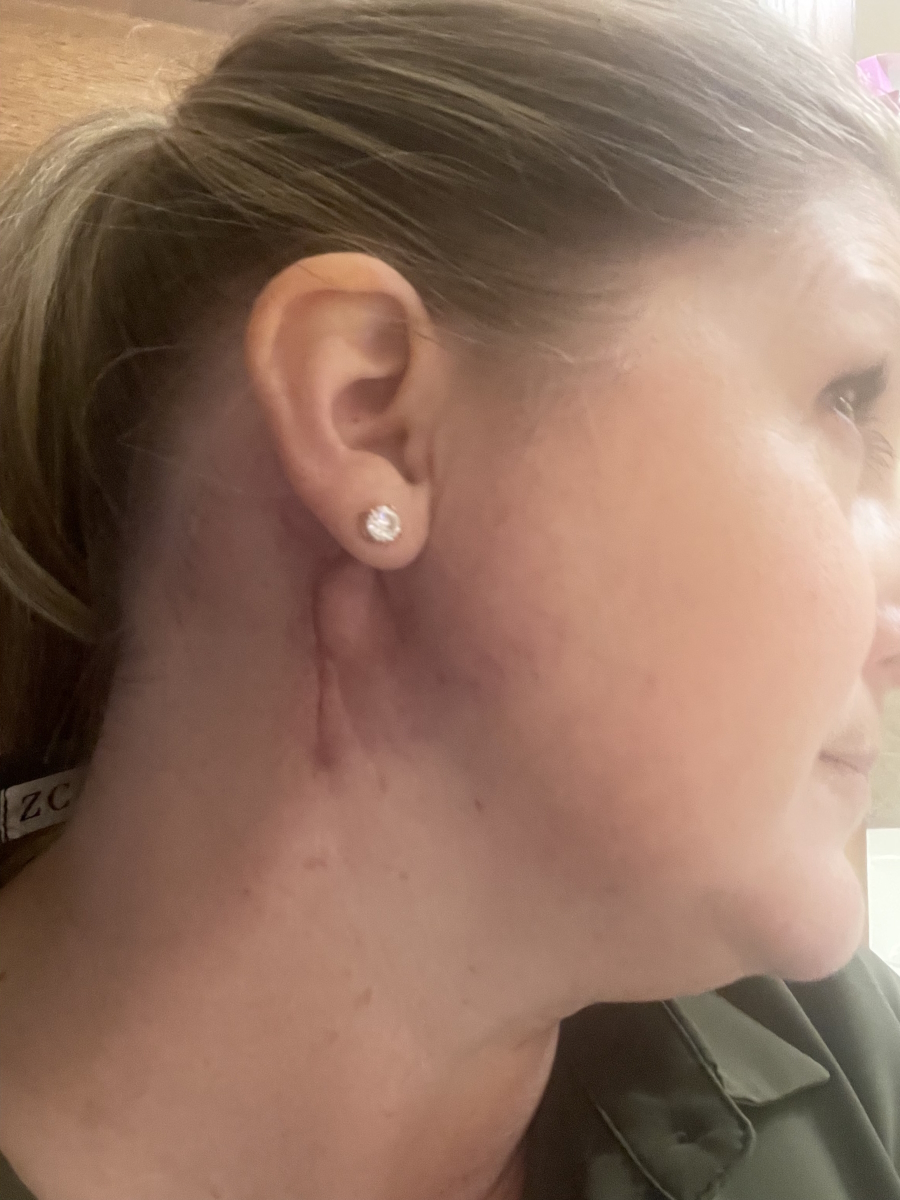 Holly A. adenoid cystic carcinoma