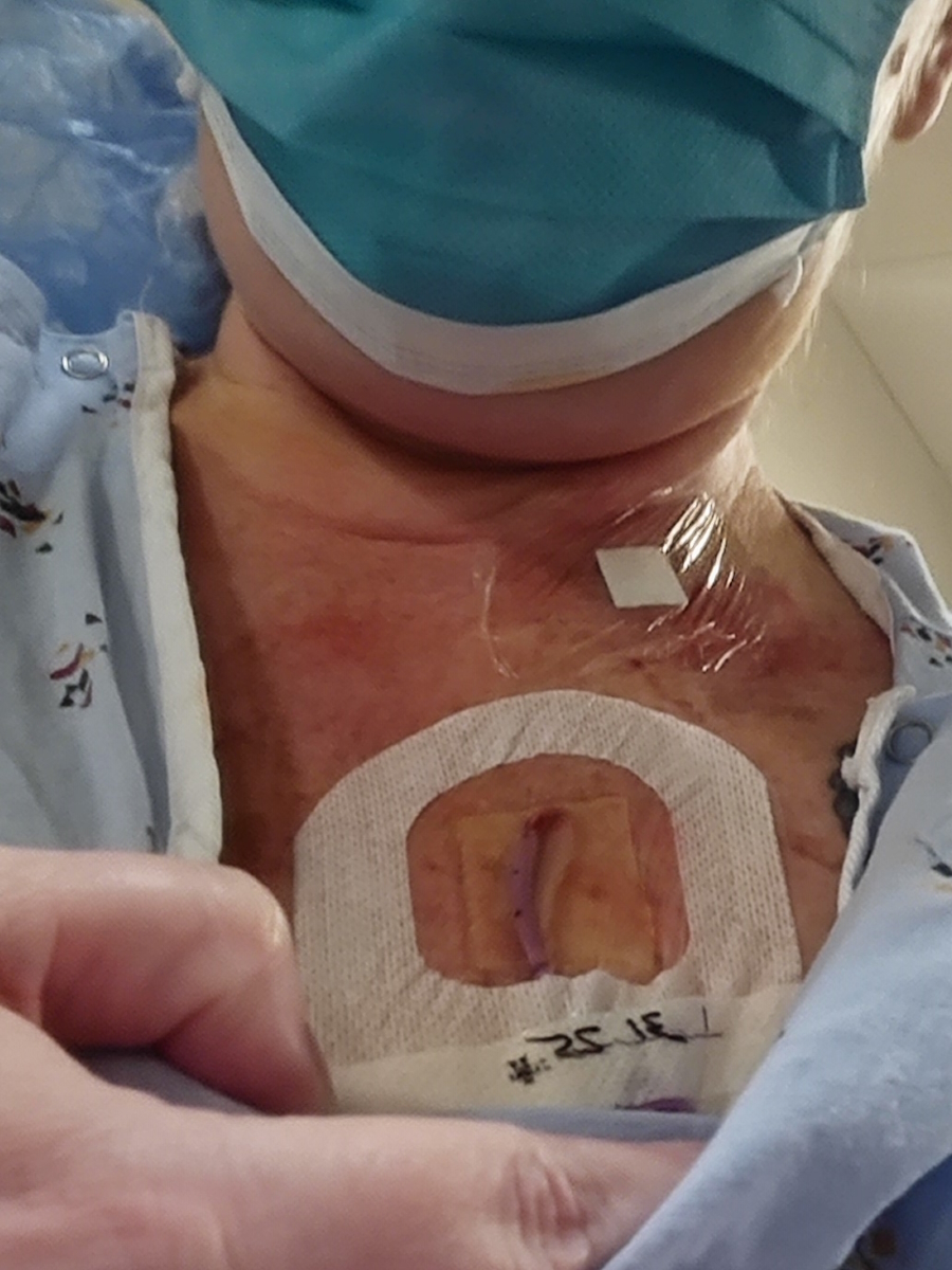 Kristen P. stage 4 small cell lung cancer