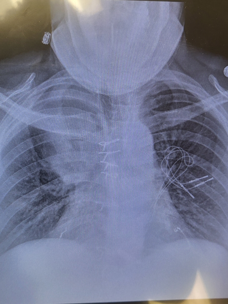 Kristen P. stage 4 small cell lung cancer
