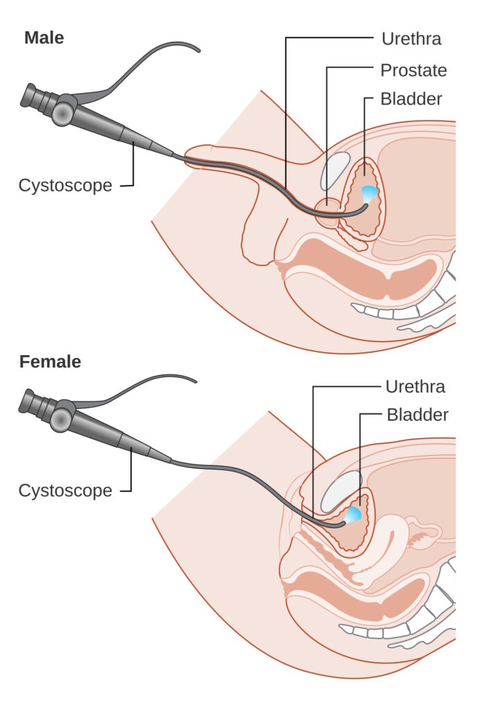 cystoscopy