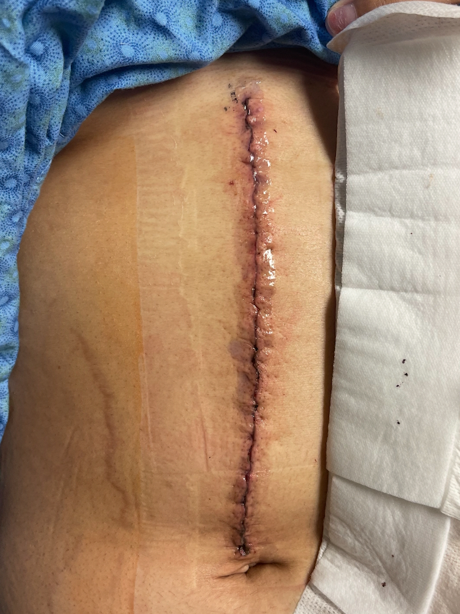 Andrea E. stage 3 neuroendocrine tumor