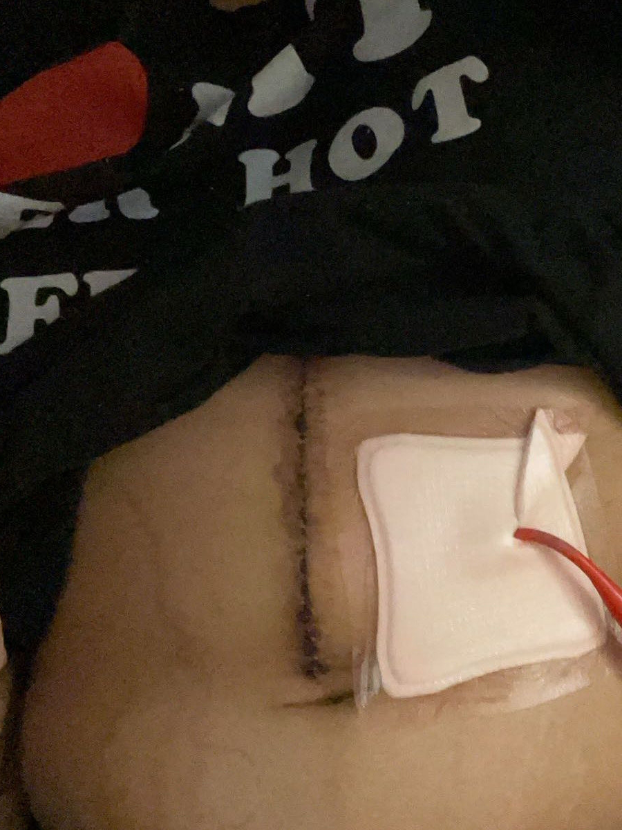 Andrea E. stage 3 neuroendocrine tumor