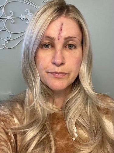 Jennifer M. stage 4 melanoma