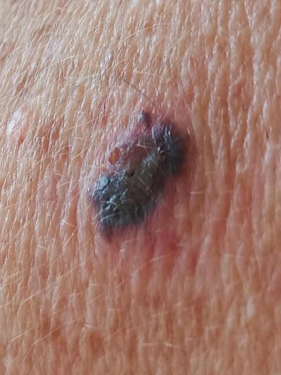 Mart H. melanoma