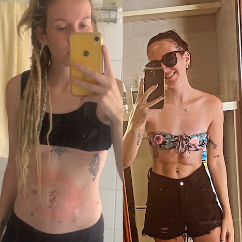 Tor K. appendix cancer