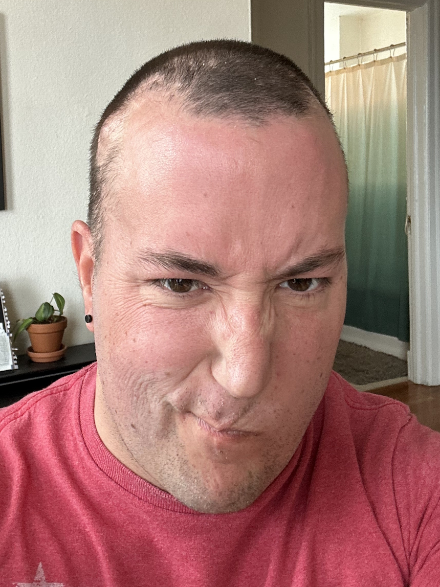 Wyatt D. stage 4 non-small cell lung cancer with KRAS G12D mutation