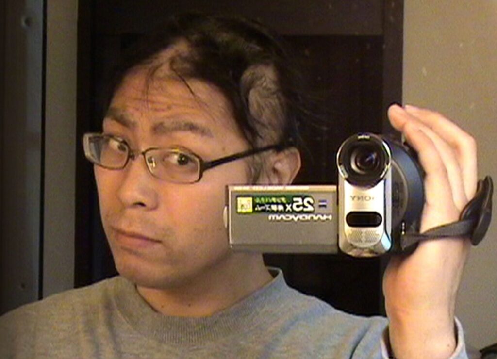 kazuo hairloss from stage 4 lung cancer treatment