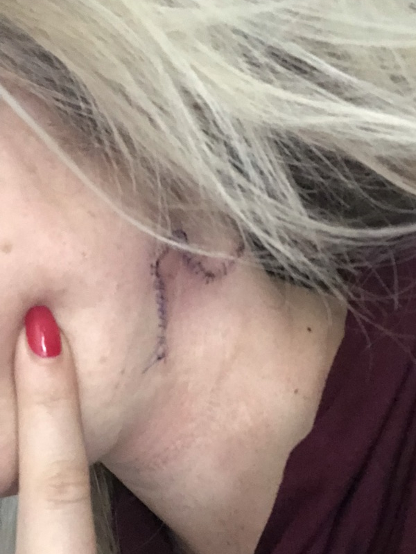 Megan S. stage 4 melanoma