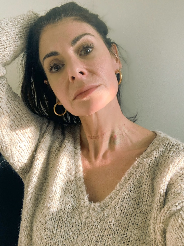 Michelle L. papillary thyroid cancer