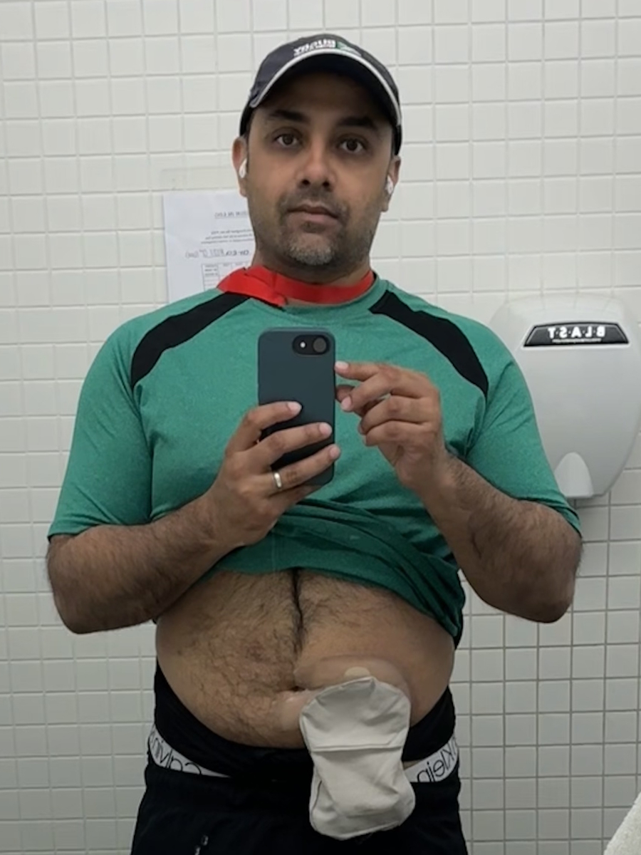Shiva S. T2 rectal cancer