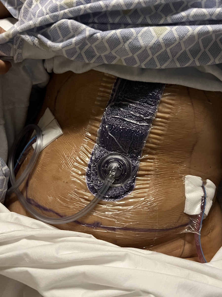 Tabbie V. neuroendocrine pancreatic cancer