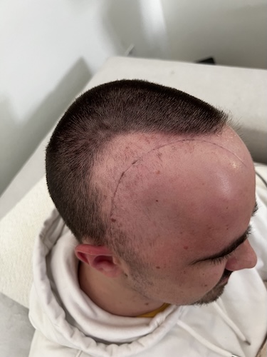 Edward H. brain cancer