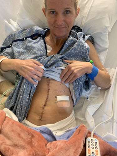 Starr S. colon cancer